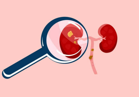The Complete Kidney Health Guide: Stones, Disease, Foods & Prevention
