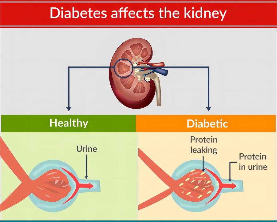 The Role of Kidney Function Measures in Detecting and Managing Renal Diseases