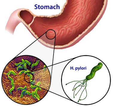 Why You Need an H. pylori Test: 6 Key Reasons Revealed