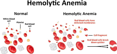 Do you know what is hemolytic anemia?