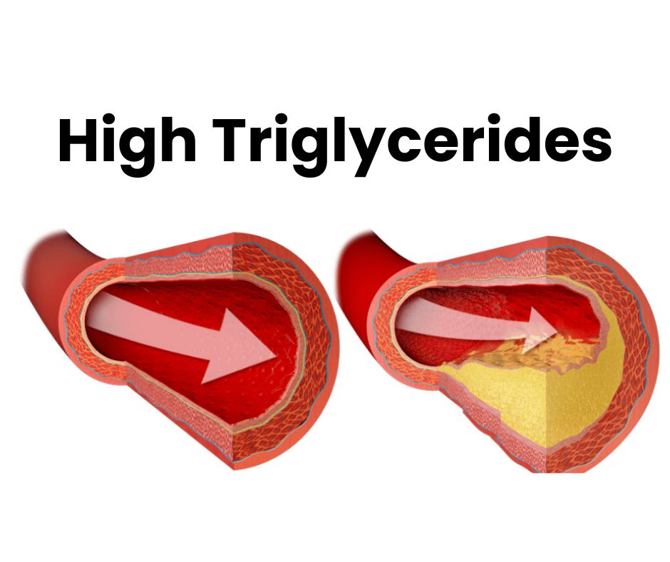 10 Risks and 7 Tips with High Triglycerides