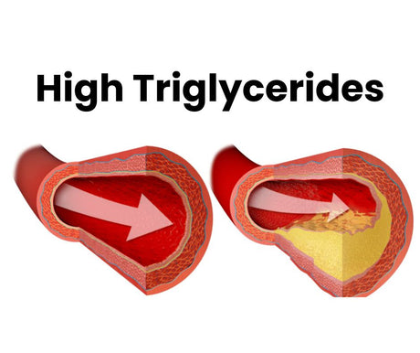 10 Risks and 7 Tips with High Triglycerides