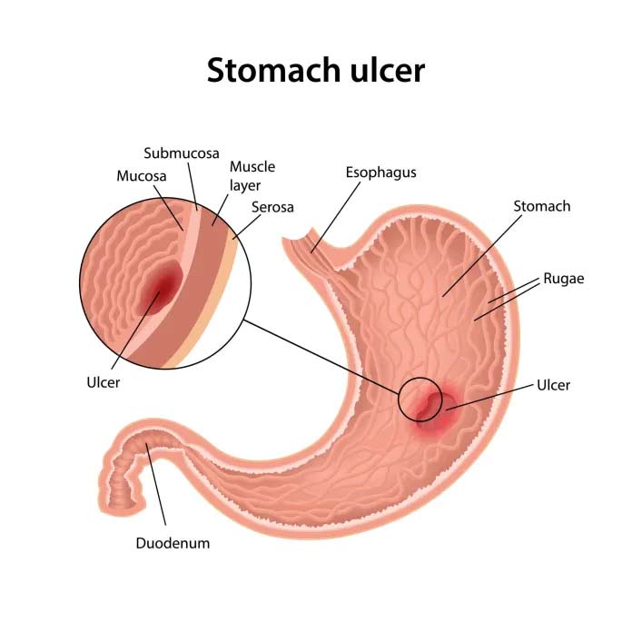 What causes gastric ulcer?