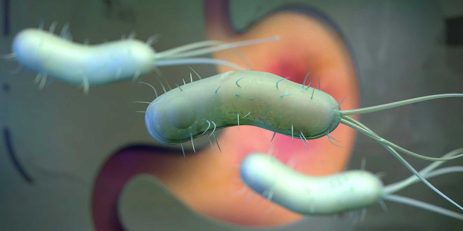 Is Helicobacter pylori a risk factor for gastric cancer?
